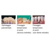 SPLINT ONE PER SPLINTAGGIO